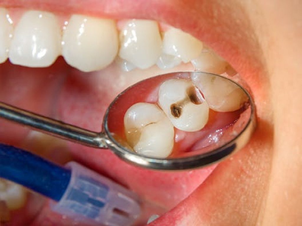 Răng bị sâu lỗ to là tình trạng sâu răng lâu ngày nhưng không được xử lý triệt để