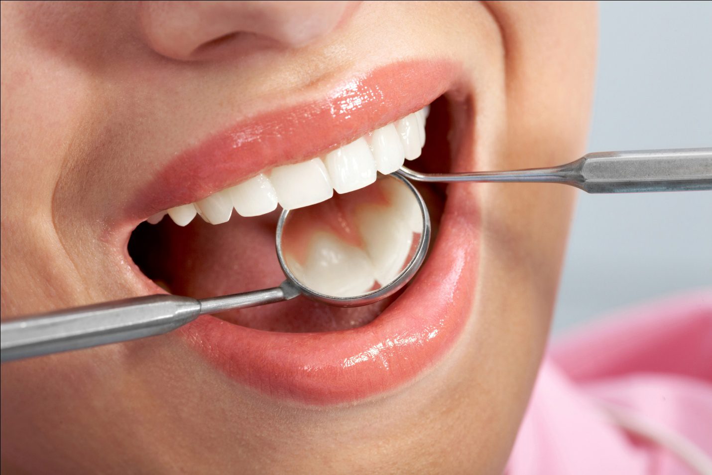 Sau khi lấy cao răng bao lâu thì được ăn? Lưu ý gì sau khi lấy cao răng 1