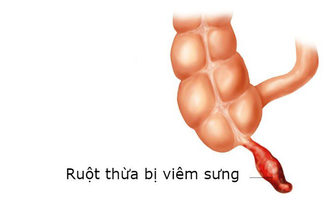 Sau mo ruot thua bao lau thi quan he duoc