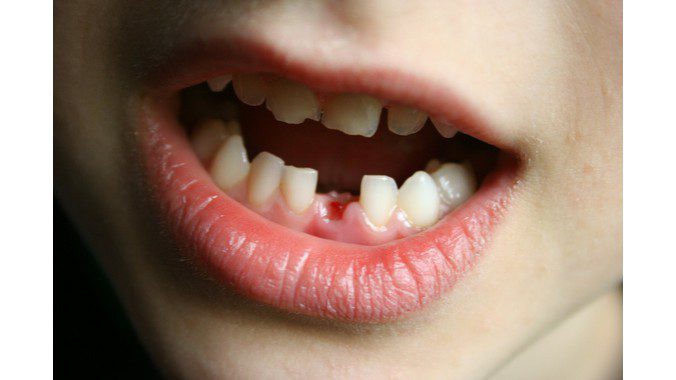 Răng cửa là răng nào và chức năng của răng cửa là gì? 2
