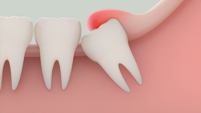 Nhổ răng số 8 có nguy hiểm không? Một số lưu ý khi nhổ răng khôn 2