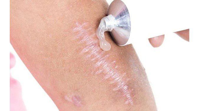 Hiruscar và Contractubex cái nào tốt hơn?3