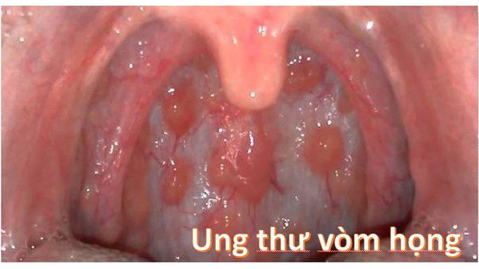 Phân biệt viêm họng hạt và ung thư vòm họng để tránh nhầm lẫn
