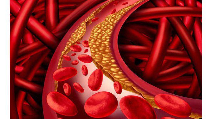 Bệnh rối loạn mỡ máu ở người cao tuổi là tình trạng rối loạn chuyển hóa lipid