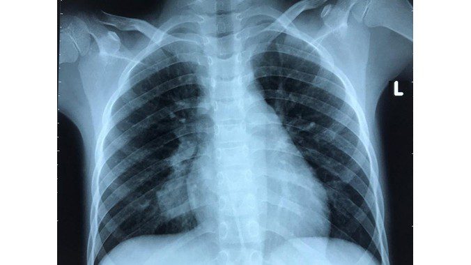 Chụp cắt lớp phổi để làm gì Các bước thực hiện ra sao 1