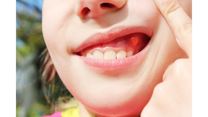 Viêm chân răng có mủ: Nguyên nhân và phương pháp điều trị 1