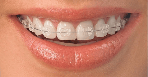 Góc giải đáp: Niềng răng mũi có cao lên không? 3 Góc giải đáp: Niềng răng mũi có cao lên không?