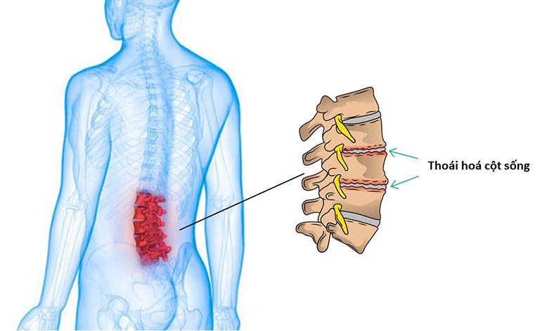 Thoái hóa cột sống thắt lưng có chữa được không? 1 Thoái hóa cột sống lưng có chữa được không? 1