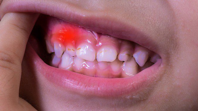 Đau răng nổi hạch dưới hàm là gì? Có nguy hiểm không? 1