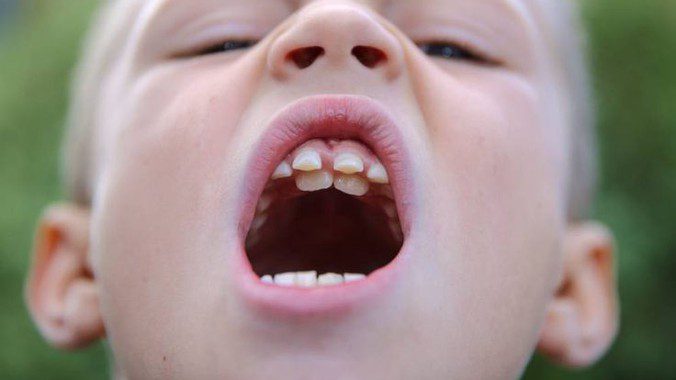 Răng thừa có nên nhổ không - Bạn đã biết chưa? 1