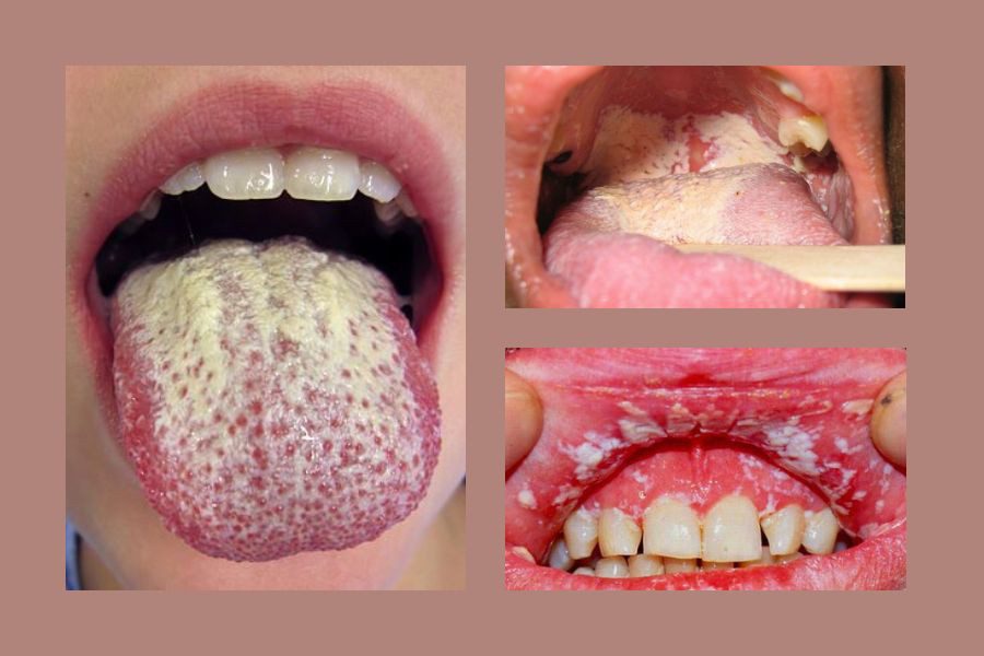 Giải đáp: Người mắc bệnh nấm miệng có bị HIV không? 1