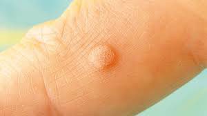 Mụn cóc là những khối u nhỏ trên da do virus u nhú ở người (HPV) gây ra