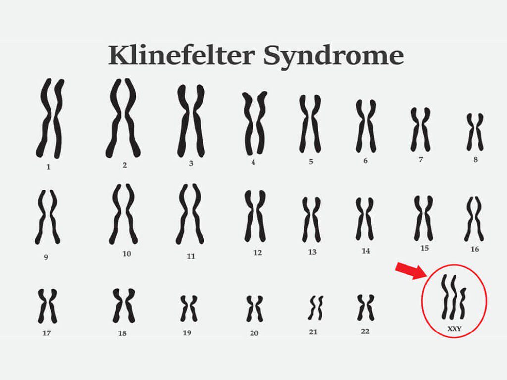 Những điều quan trọng nam giới cần biết về hội chứng Klinefelter 1