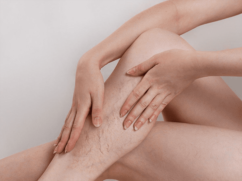 Giải đáp thắc mắc: Dầu dừa có trị giãn tĩnh mạch không? 2 Giải đáp thắc mắc: Dầu dừa có trị giãn tĩnh mạch không? 1