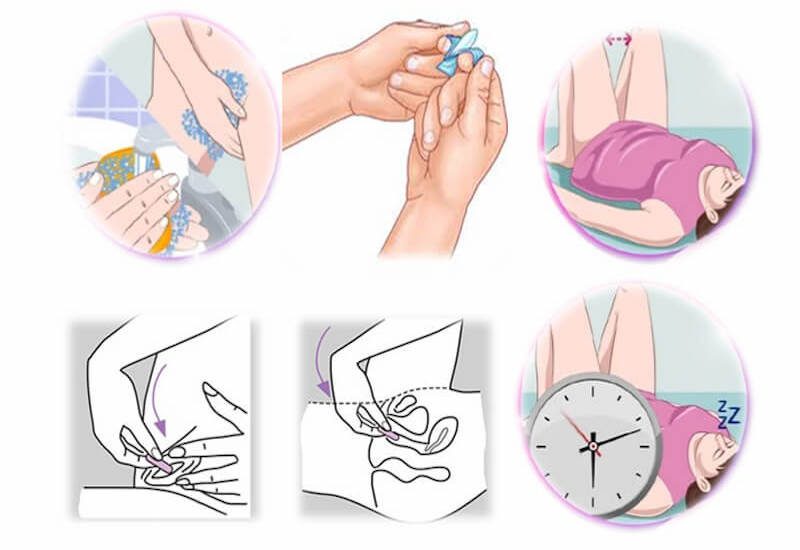 Một số lưu ý quan trọng khi dùng thuốc đặt âm đạo