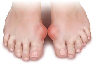 Triệu chứng bệnh gout gây tình trạng sưng khớp đốt bàn chân